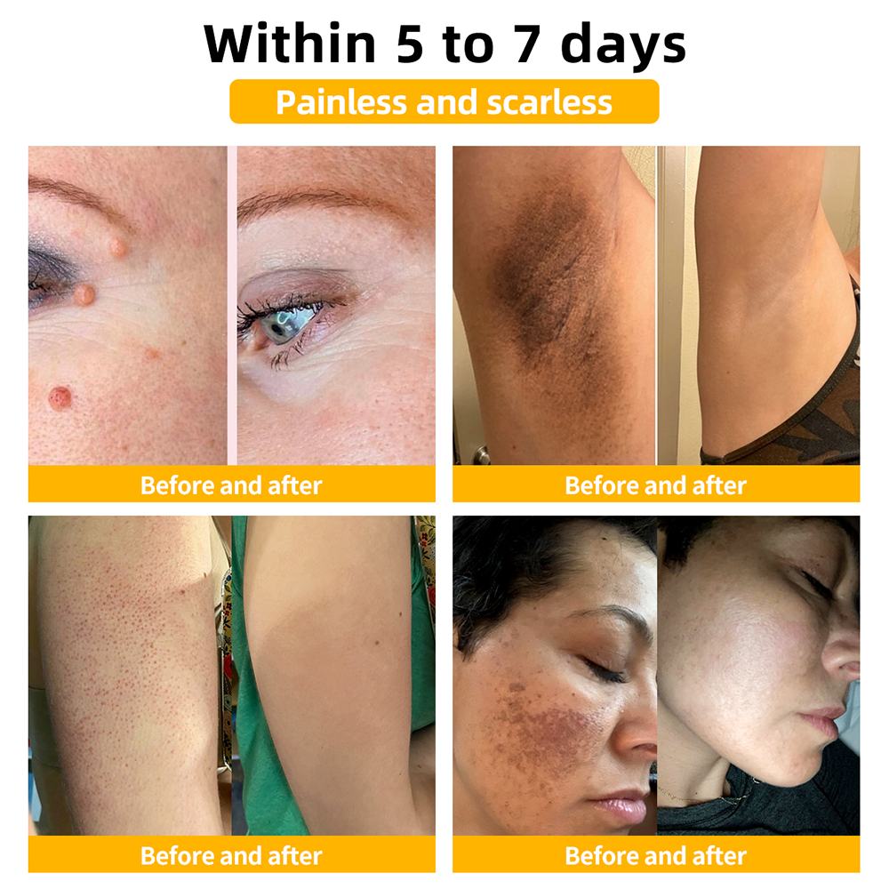 Lovildsβ’ Bee Venom Skin Treatment CreamοΌπ΄π΄π· π
πππππππππποΌ