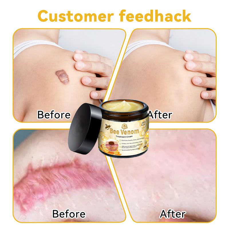Lovildsβ’ Bee Venom Skin Treatment CreamοΌπ΄π΄π· π
πππππππππποΌ