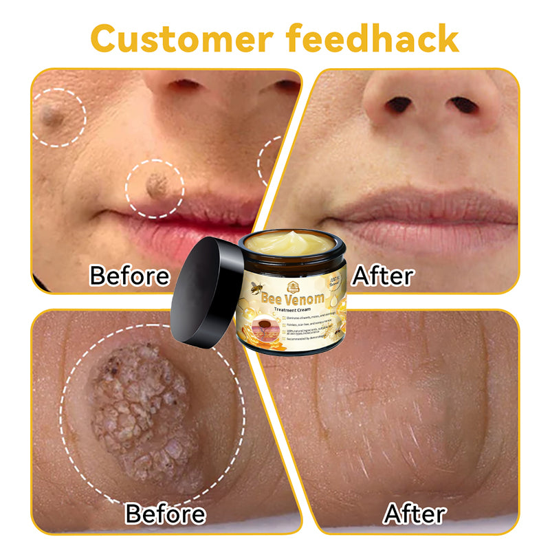Lovildsβ’ Bee Venom Skin Treatment CreamοΌπ΄π΄π· π
πππππππππποΌ