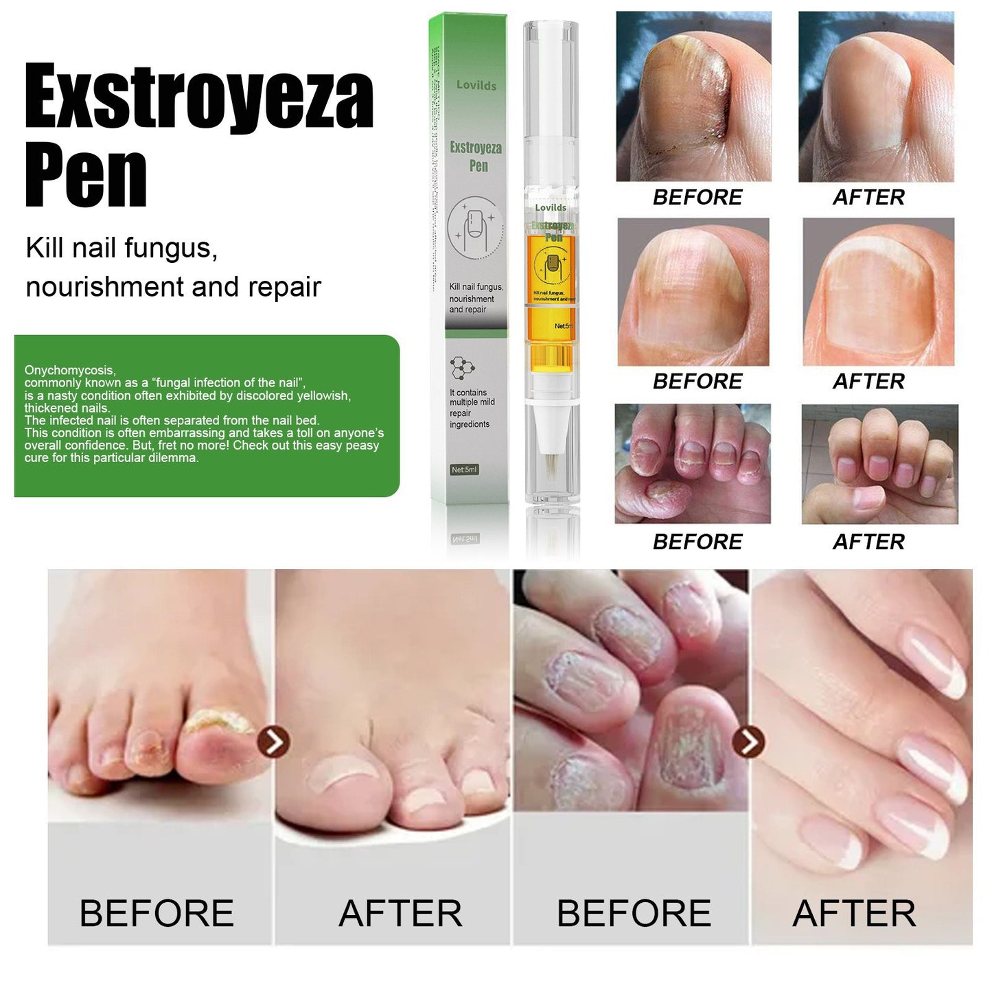 Anti-Fungal Pen – Gets Rid Of Even the Most Stubborn Nail Fungus