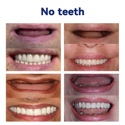 NESLEMY™🦷Advanced Customized Full Denture Set🦷 (⏰Limited time discount last 30 minutes⏰)