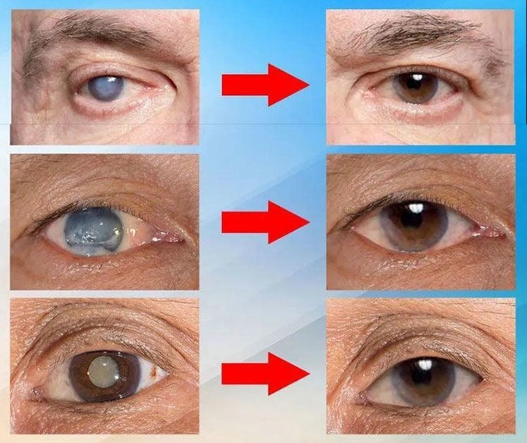 Japan Vision Drops — Rapidly Heals All Eye Conditions & Restores Vision